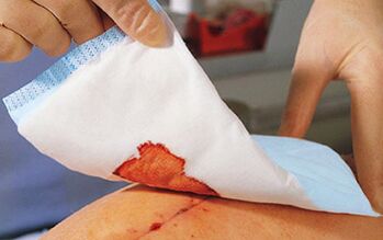 After penis enlargement surgery, dressings are required