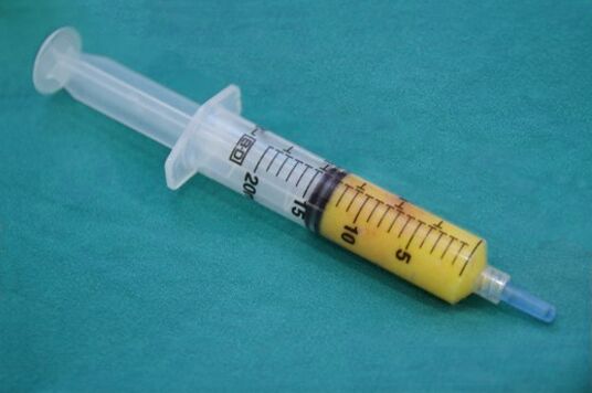 Syringe with adipose tissue for lipofilling