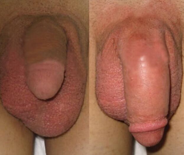 The result of installing a collagen matrix in the penis