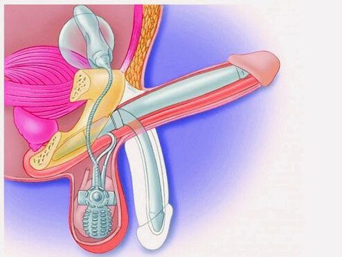 Penis enlargement through penile prosthesis