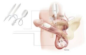 insertion of implants in the penis